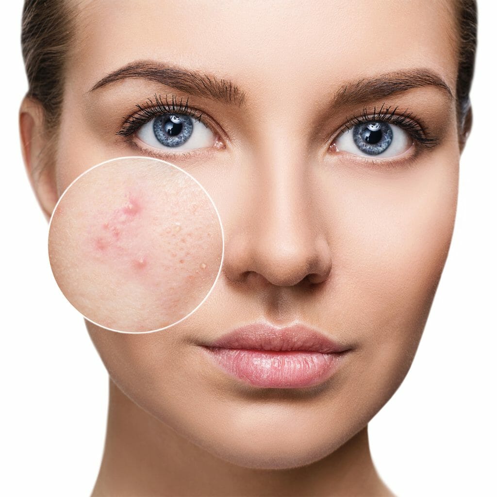 Acne facial, extractions